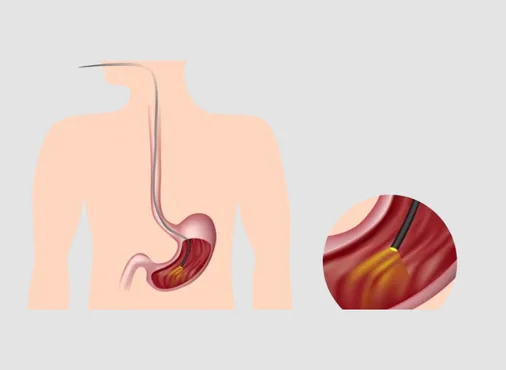 Upper GI Endoscopy (OGD Scope - Oesophago-Gastro-Duodenoscopy) consultation at Niraaya Hospital